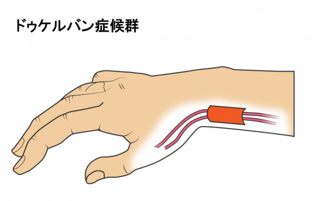 腱と腱鞘イラスト